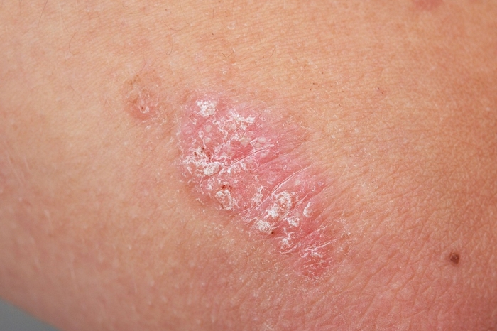 Psoriasis UVB Treatments